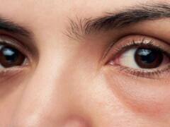 Eye Beauty Tips : સોજેલી આંખો આપના સૌદર્યમાં બને છે બાધક,  આ સરળ ઘરેલુ ઉપાયથી મેળવો  છૂટકારો