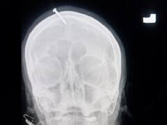 Nail on Head: మగబిడ్డ పుట్టాలని తలలో మేకు దిగ్గొట్టుకుంది, గర్భిణీకి స్వామీజీ సలహా, చివరికి ఏమైందంటే