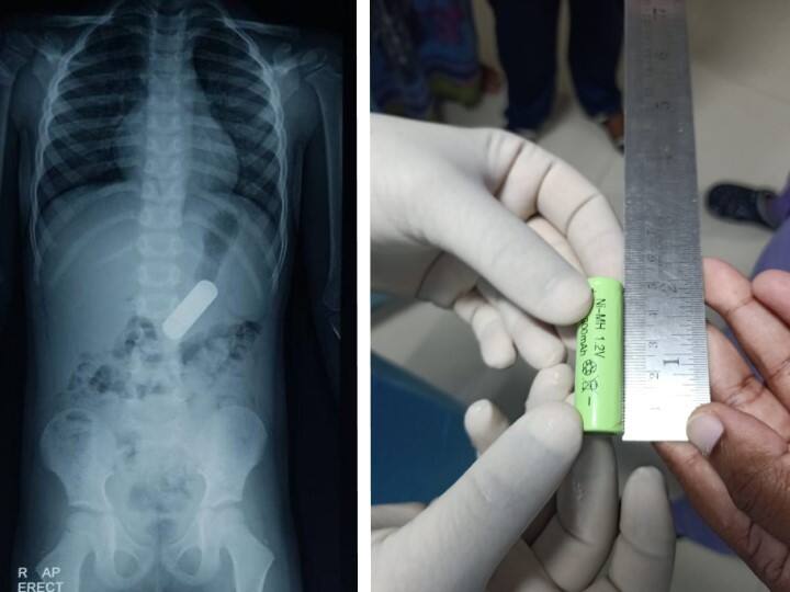 Boy Ingested Battery, Doctors save his life without surgery in Chennai Battery in Stomach: ఓ మై గాడ్, పసివాడి కడుపులో బ్యాటరీ, సర్జరీ చేయకుండా ఇలా తీసేశారు!