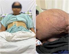 Gujarat News: गुजरात में डॉक्टरों ने महिला के पेट से निकाला 47 किलो वजनी ट्यूमर, दिया नया जीवन