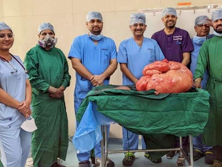 Apollo Doctors Remove 47-Kg Tumour From Woman's Abdomen, Biggest Non-Ovarian Tumour In Indian Record Doctors Remove 47-Kg Tumour From Woman's Abdomen, Biggest Non-Ovarian Tumour In Indian Records