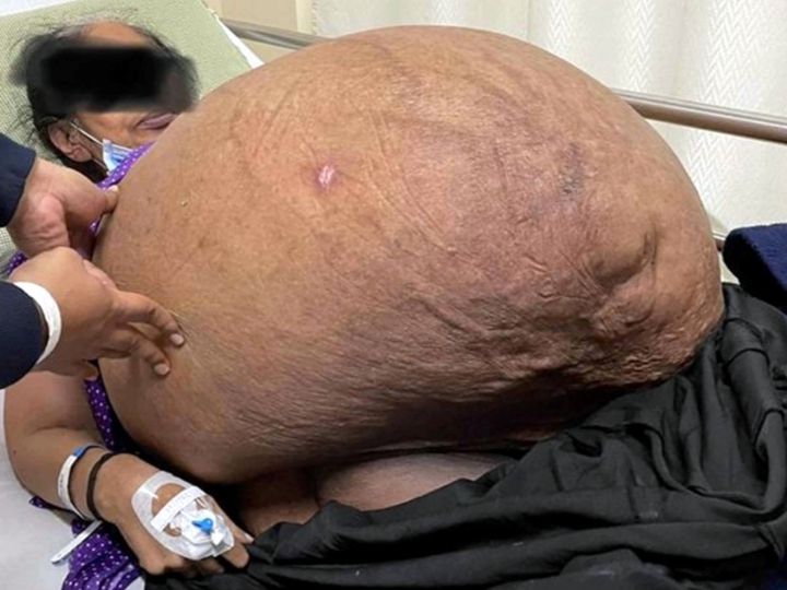 Doctors Remove 47-Kg Tumour From Woman's Abdomen, Biggest Non-Ovarian Tumour In Indian Records