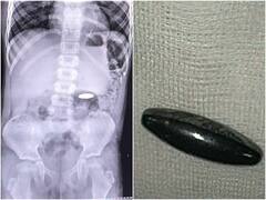 Vijayawada: అయస్కాంతం మింగేసిన 8 ఏళ్ల బాలుడు, ఆపరేషన్ లేకుండా ఎలా తీశారంటే!