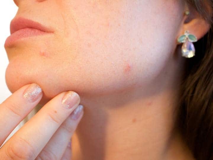 Here are some effective tips to reduce acne Beauty: మొటిమలను తగ్గించే ప్రభావవంతమైన చిట్కాలు ఇవిగో