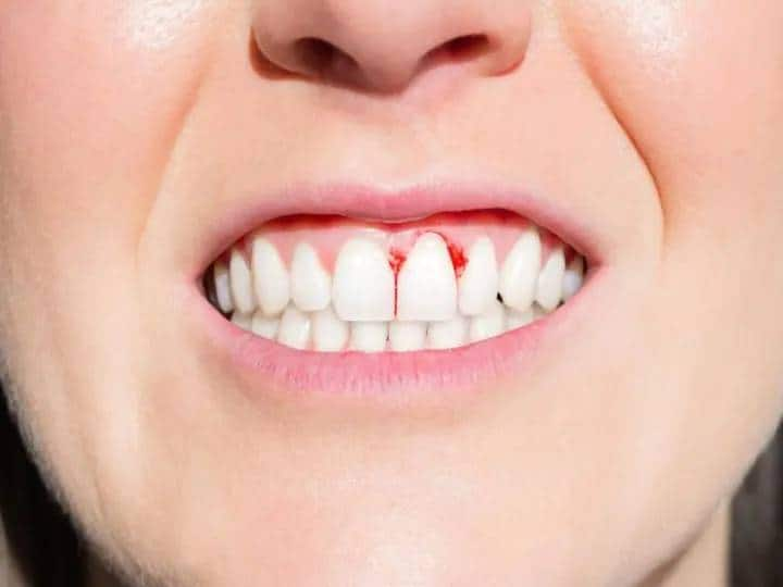 Use this home remedies to get rid off from gum problems Bleeding Gum : हिरड्यांच्या समस्यांनी त्रस्त आहात? ‘या’ सोप्या उपायांनी मिळवा आराम!