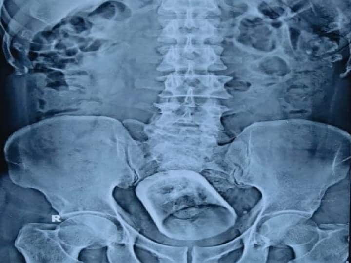 Glass in the stomach, doctors removed by surgery Viral News: పొట్టలో టీ గ్లాసు, ఎలా మింగేశావయ్య బాబూ అంటూ తల పట్టుకున్న వైద్యులు