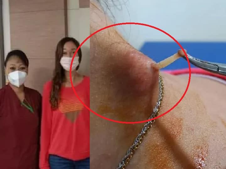 Delhi surgeons remove 3 live botflies from American woman’s eye after US doctors fail to do so கண்ணுக்குள்ள ஏதோ நகருது! பெண் உடலுக்குள் உயிருடன் ஊடுறுவிய 3 ஒட்டுண்ணி! அதிர்ச்சி சம்பவம்!