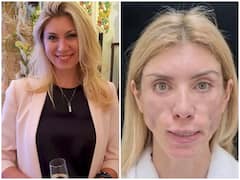 प्लास्टिक सर्जरी ने बिगाड़ा ब्यूटी क्वीन का खिताब जीतने वाली महिला का फेस, अब होने लगी ये परेशानी