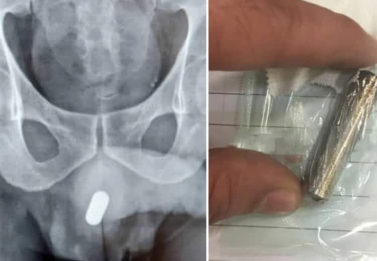 A man admitted to hospital with AA battery in his penis in Tehran of Iran ஆணுறுப்பில் பேட்டரியை சொருகி சிக்கலில் சிக்கிய இளைஞர்!  பாலியல் உச்சத்துக்காக விபரீதம்.!