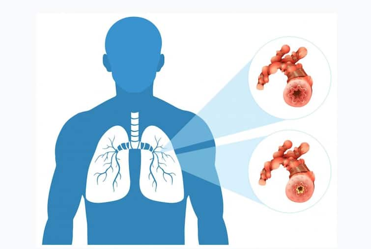 Chhattisgarh News Tuberculosis and other diseases Free treatment in Chhattisgarh Government decision ann Chhattisgarh News: छत्तीसगढ़ में मुफ्त होगा टीबी जैसी गंभीर बीमारियों का इलाज, जानें क्या हैं लक्षण और बचाव के तरीके