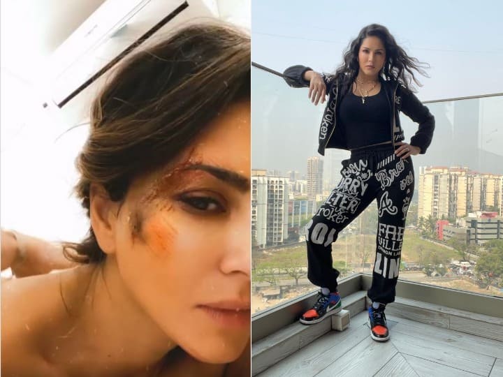sunny leone wounded shares video on social media सनी लियोनी के चेहरे पर लगी गहरी चोट, वीडियो शेयर कर दिखाए घाव