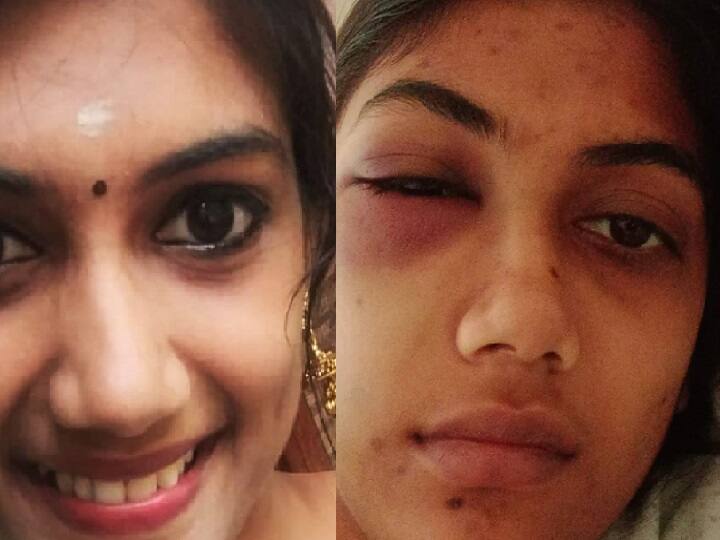 kerala woman brutally assaulted for exposing mother in law illicit relationship Crime Crime : சிதைந்த முகம்! மருமகளுக்கு குடிக்க டாய்லெட் தண்ணீர்.. தகாத உறவால் பாதைமாறிய கொடூர மாமியார்!