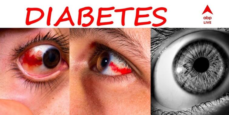 Diabetes Can Affect Your Eyes & Vision Diabetic Retinopathy Cataract Glaucoma ABP Exclusive Diabetes Eye Problems : এই উপসর্গগুলি অবহেলা করলে ডায়াবেটিস কাড়তে পারে দৃষ্টিশক্তিও
