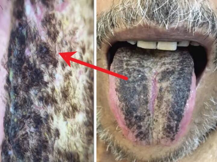 Black Hair Grows on Man's Tongue, Turns out it's common condition Hair on Tongue: ఓ మై గాడ్, ఇతడి నాలుకపై జుట్టు పెరుగుతోంది, కారణం తెలిస్తే ఇక నిద్రపట్టదు!