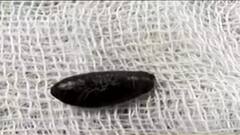 SSKM: এসএসকেএমে এক বছরের শিশুর সফল অস্ত্রোপচার, শ্বাসনালি থেকে বের করা হল কুলের বীজ | Bangla News