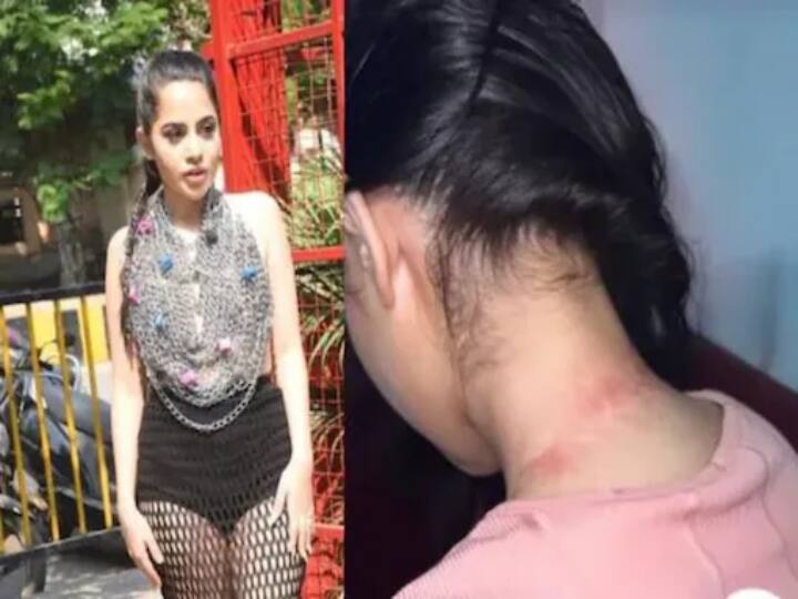 Urfi Javed Fashion dress make a Cause Injury Urfi Javed : மேலாடையே இல்லை.. இது செயின் ஆடை.! தேவையில்லாமல் காயம்பட்ட உர்ஃபி!