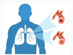 ਭਾਰਤ 2024 ਤੱਕ ਤਿਆਰ ਕਰ ਲਏਗਾ ਟੀਬੀ ਦੀ ਵੈਕਸੀਨ, ਤੀਜੇ ਪੜਾਅ ਦਾ ਟਰਾਇਲ ਜਾਰੀ