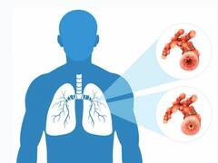 बिहार: राजधानी में कम हुई टीबी के मरीजों की संख्या, 3 महीने में कम हुए 1368 मरीज, प्रदेश में एक साल में मिले 1.32 लाख नए केस