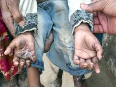 Rajasthan के इस जिले में फैली संक्रामक बीमारी, बच्चों की हथेलियों से निकल रहा खून, मिले 35 मरीज