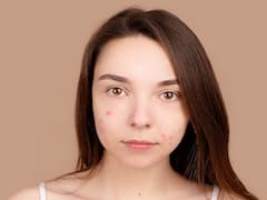 Acne: ఈ ఆహారాలకు దూరంగా ఉంటే మొటిమలు రావు, ఈ సమస్య ఎంతమందిని వేధిస్తోందో తెలుసా?