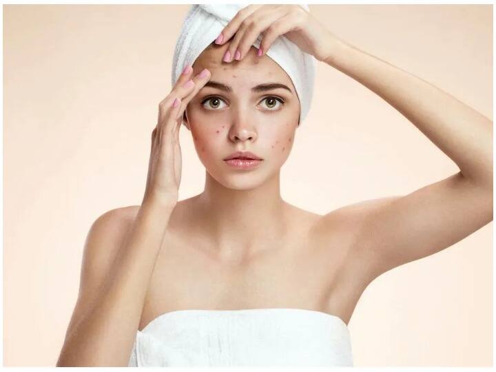 Health Tips, Pimples will be cured in a day with these Home Remedies, Skin Care Tips इन घरेलू नुस्खों से पिंपल्स एक दिन में होगें ठीक, जानें