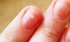 Milk Spot: নখে সাদা সাদা দাগ! কোনও রোগের প্রাথমিক লক্ষণ এটি?
