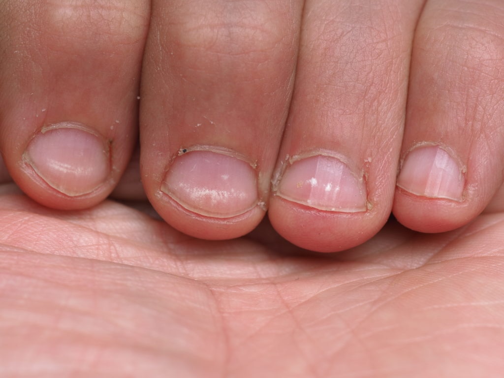 What Do Nail Problems Mean for Your Health?