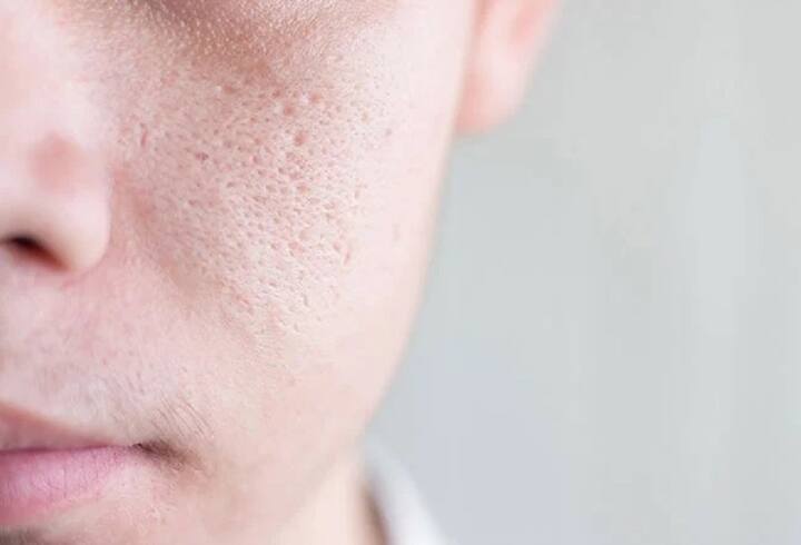 પોર્સ (pores) નાના બનાવો: જ્યારે ખુલ્લા છિદ્રો (pores)નું કદ મોટું થાય છે, ત્યારે તેમાં ઝડપથી ધૂળ અને માટી એકઠા થાય છે. આવી સ્થિતિમાં પિમ્પલ્સની સમસ્યા તો થવાની જ છે. આ માટે તમારે ત્વચાને કડક બનાવવા સંબંધિત ઉપાયો અપનાવવા જોઈએ. પાઈનેપલના પલ્પમાં થોડું દહીં મિક્સ કરીને ચહેરા પર લગાવો. આ કુદરતી પેક સુકાઈ જાય પછી તેને હૂંફાળા પાણીથી સાફ કરો.