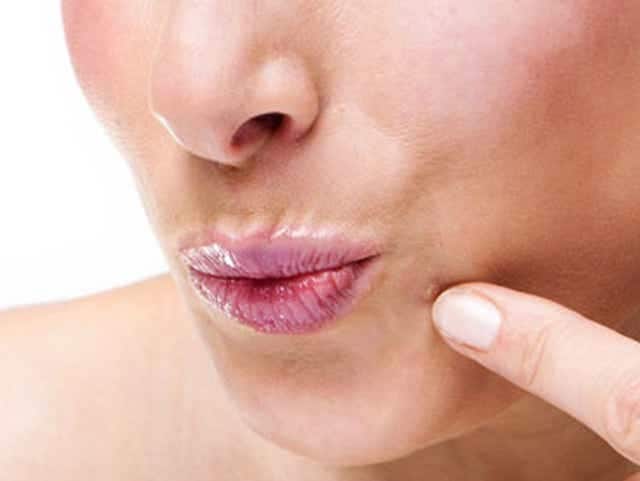 After all why there are warts on the face and body know complete information relatedto it Health tips : આ કારણે  ચહેરા અને શરીર પર નીકળે છે, મસ્સા,  જાણો એક્સ્પર્ટે શું આપી સલાહ