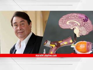 Dementia : बॉलिवूड अभिनेते रणधीर कपूर यांना 'स्मृतिभ्रंश'; जाणून घ्या लक्षणं आणि उपचार