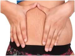स्ट्रेच मार्क से हैं परेशान? तो घर पर इस तरह बनाएं स्ट्रेच मार्क रिमूवल क्रीम