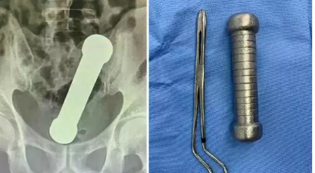 The man put a dumbbell in his private part, the doctors were blown away after seeing the x-ray ਸ਼ਖਸ ਨੇ ਆਪਣੇ ਪ੍ਰਾਈਵੇਟ ਪਾਰਟ 'ਚ ਪਾ ਲਿਆ ਡੰਬਲ , ਐਕਸਰੇ ਦੇਖ ਕੇ ਡਾਕਟਰਾਂ ਦੇ ਉੱਡੇ ਹੋਸ਼