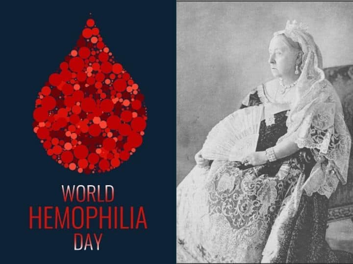 World Haemophilia Day 2022: What Is Haemophilia And Why It Is Known As 'Royal Disease' | EXPLAINED World Haemophilia Day 2022: What Is Haemophilia And Why It Is Known As 'Royal Disease' | EXPLAINED