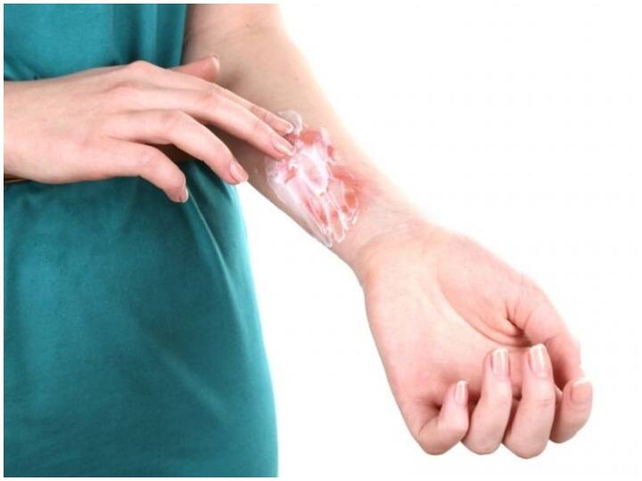 Health Tips, Do not make these mistakes when your hands are Burnt, Health Care Tips किचन में काम करते समय अगर जल जाए हाथ तो भूल से भी न करें ये गलतियां