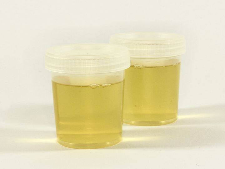 If there are tumors in the brain the urine test can detect that thing, the result of a new study Urine Test: మెదడులో కణితులుంటే మూత్రపరీక్షలో ఆ విషయం పసిగట్టేయచ్చు, కొత్త అధ్యయనం ఫలితం