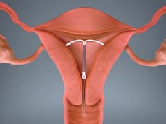 Copper-T: గర్భం ధరించకుండా వేయించుకునే లూప్ ఎంత కాలం తరువాత మార్చాలి?