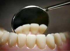 ਸ਼ਖਸ ਨਾਲ ਵਾਪਰਿਆ ਭਿਆਨਕ ਹਾਦਸਾ, ਦੰਦਾਂ ਦੇ ਡਾਕਟਰ ਦੀ ਡਰਿੱਲ ਬਿਟ ਨਿਗਲੀ