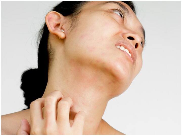 Health Tips, Follow Methods to get rid of Itching Problem Itching Problem: खुजली की समस्या से हैं परेशान? तो एलोवेरा करेगा आपकी मदद