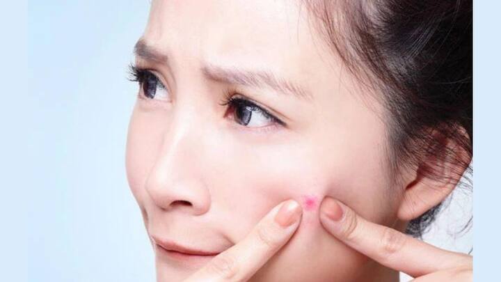 ব্রণর সমস্যায় ভুগছেন ? খাদ্যাভ্যাসে কিছু পরিবর্তন এনে এই সমস্যার সমাধান করতে পারেন।