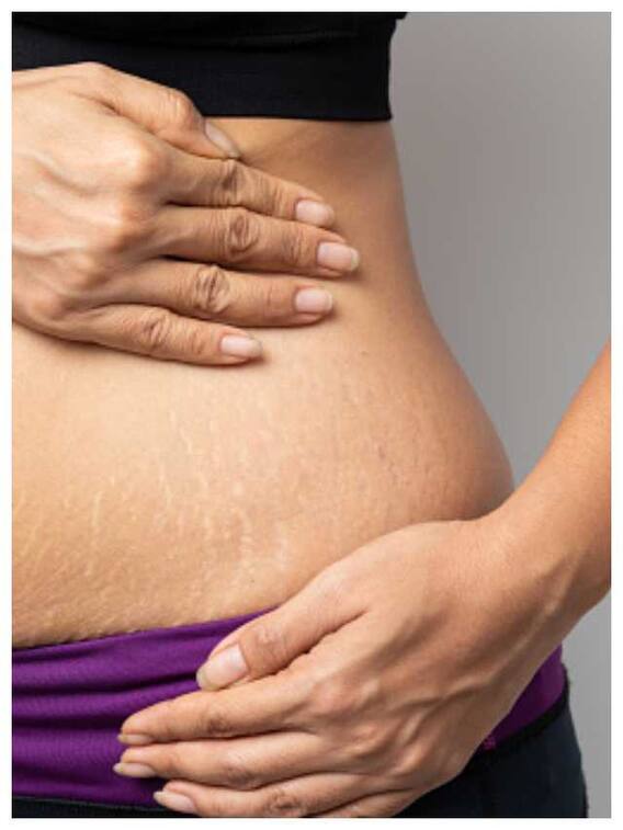 स्ट्रेच मार्क्स हटाने के घरेलू उपाय