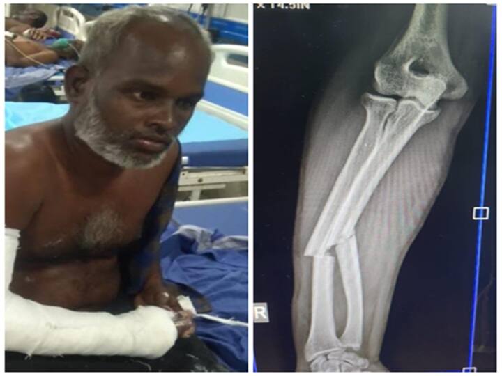 Tirunelveli Police SI Market Theresa stabbed by Arumugam Tirunelveli: பெண் போலீசை நேரில் சந்தித்த டிஜிபி! வழுக்கி விழுந்ததில் குற்றவாளிக்கு உடைந்த கை எலும்பு!!