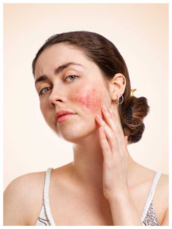 स्किन रैशेज से छुटकारा पाने के लिए अपनाएं ये नुस्खे