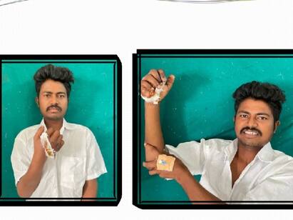 Coimbatore government doctors reattach the severed youths hand துண்டிக்கப்பட்ட இளைஞனின் கையினை மீண்டும் பொருத்தி கோவை அரசு மருத்துவர்கள் அசத்தல்..!