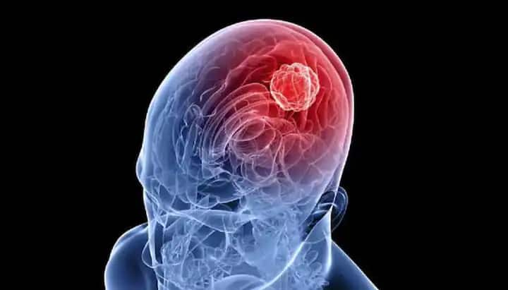 Brain tumor does mobile use cause brain tumor shocking revelations made in the uk million women study Brain tumor : मोबाईलच्या अति वापरामुळे होतो ब्रेन ट्युमर? अभ्यासात धक्कादायक खुलासा समोर