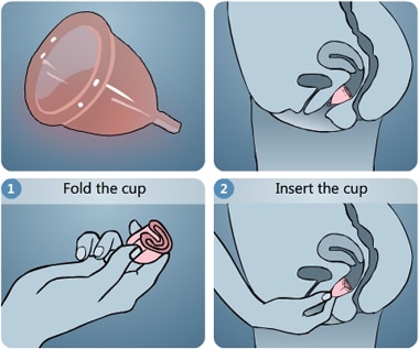 Menstrual Cup: మెన్‌స్ట్రువల్ కప్ చూసి భయపడకండి, దాన్ని వాడడం చాలా సులువు
