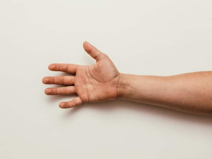 man who has penis hanging from his arm for six years finally fitted అతడి అంగాన్ని చేతికి కుట్టేసిన వైద్యులు, కారణం తెలిస్తే మైండ్ బ్లాక్ అవుతుంది!