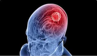 Mobile Causes Brain Tumor: মোবাইল ব্যবহারে কি ব্রেন টিউমার হয়? গবেষণায় উঠে এসেছে চাঞ্চল্যকর তথ্য