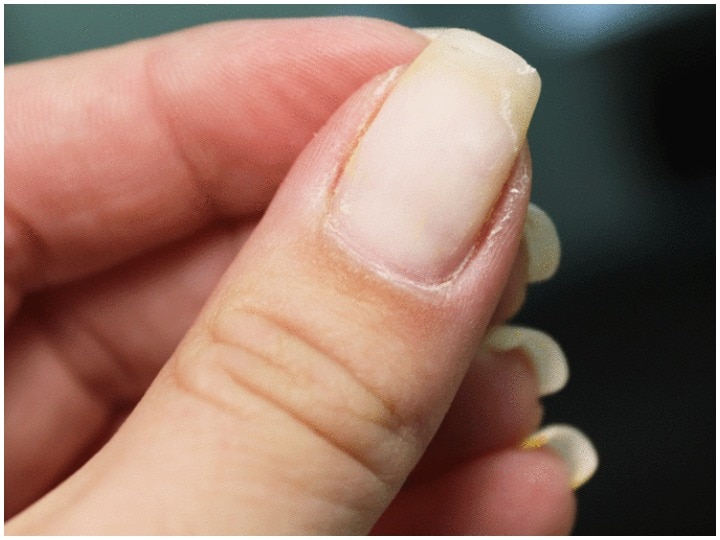 Home Remedies For Dry Cuticles And Peeling Skin Around Nails Cause Of Dry  Cuticles | Health Tips: नाखून के पास चिट क्यों उखड़ती है, इस तरह नहीं  निकलेगी नाखून के पास की