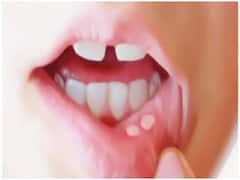 Home Remedies for Mouth Ulcers: अगर परेशान हैं मुंह के छालों से तो अपनाएं ये घरेलू नुस्खे