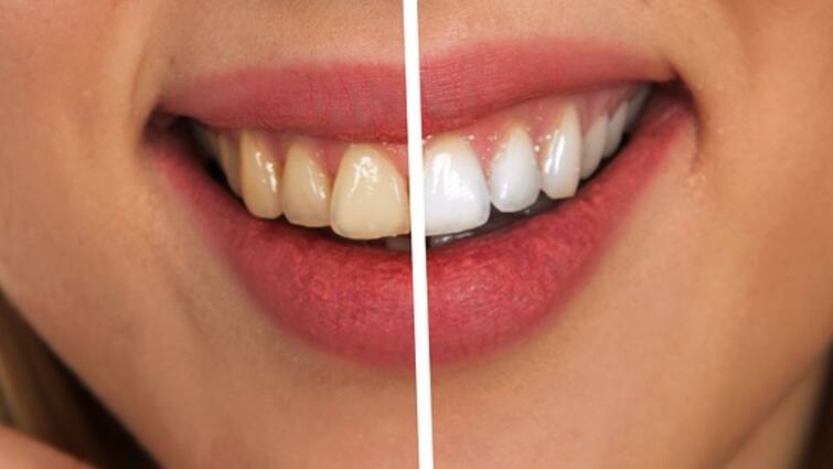 How to Get Rid of Yellow Teeth, know in details Health Tips: হলুদ ছোপ পড়েছে? সহজ পদ্ধতিতে পান ঝকঝকে সাদা দাঁত